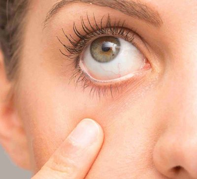 درمان خشکی چشم