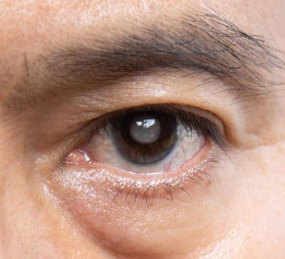 درمان آب مروارید