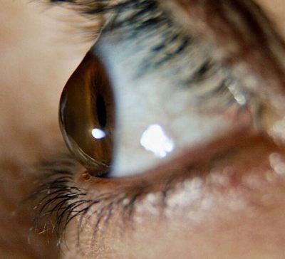 درمان قوز قرنیه