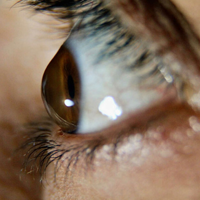 درمان قوز قرنیه