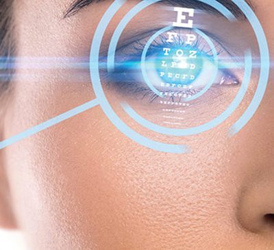 عمل فمتو لیزیک