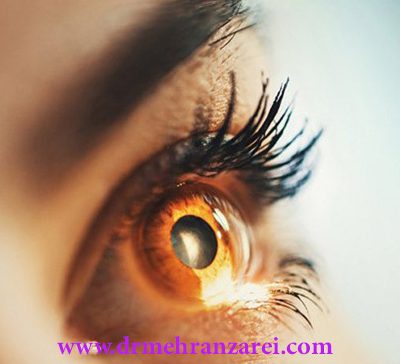 تخفیف عمل لیزیک