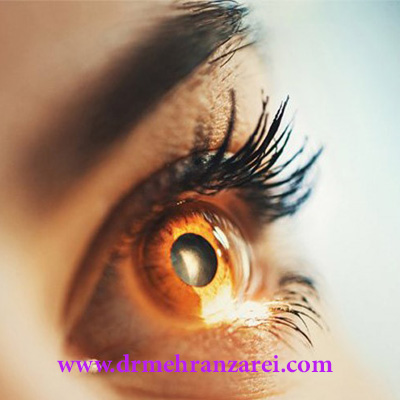 تخفیف عمل لیزیک