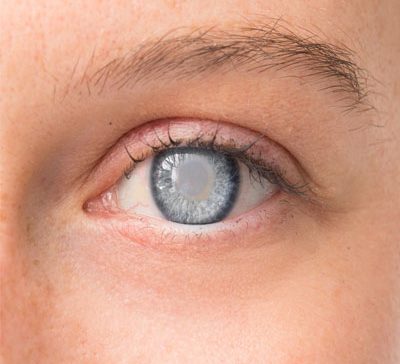 دوران نقاهت بعد از عمل آب مروارید