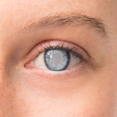 دوران نقاهت بعد از عمل آب مروارید