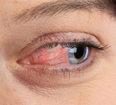 عمل تخلیه چشم