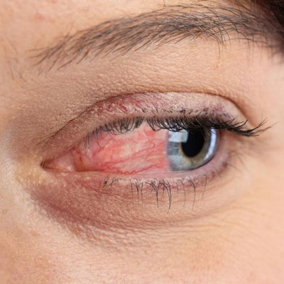 عمل تخلیه چشم