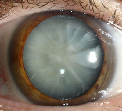 عمل چشم آب مروارید