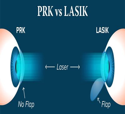 تفاوت عمل لیزیک و لازک