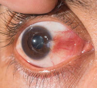 بهترین روش برای از بین بردن ناخنک چشم