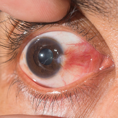 بهترین روش برای از بین بردن ناخنک چشم