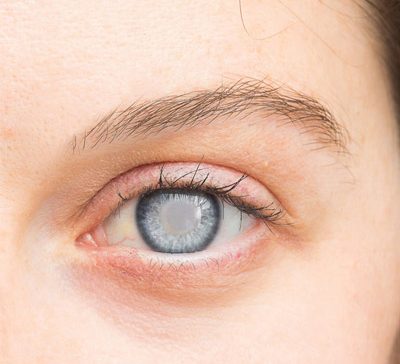 جابجایی لنز بعد از عمل آب مروارید