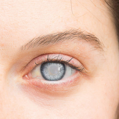 جابجایی لنز بعد از عمل آب مروارید