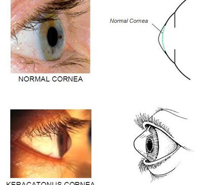 علائم قوز قرنیه چیست