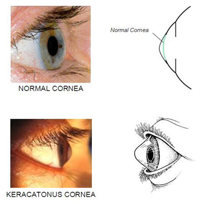 علائم قوز قرنیه چیست