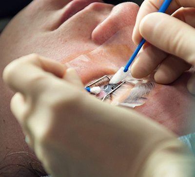 عمل لازک چشم آستیگمات