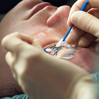 عمل لازک چشم آستیگمات