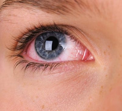 عوارض درمان نکردن خشکی چشم