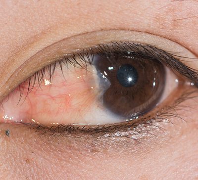 آیا ناخنک چشم از بین میرود