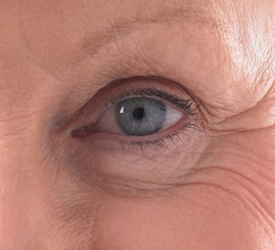 درمان پیرچشمی