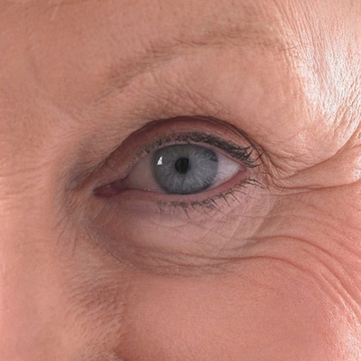 درمان پیرچشمی