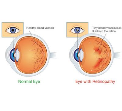 رتینوپاتی دیابتی