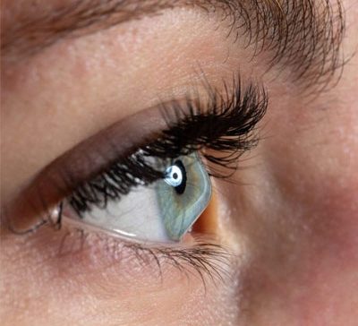 قوز قرنیه و ورزش