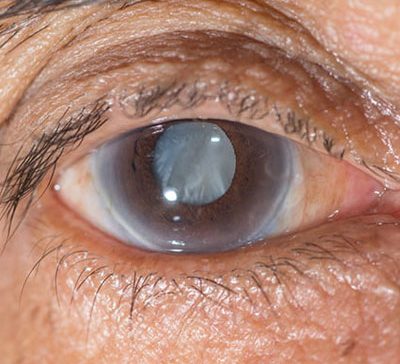 علائم آب مروارید