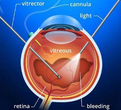 جراحی ویترکتومی