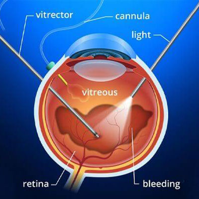 جراحی ویترکتومی