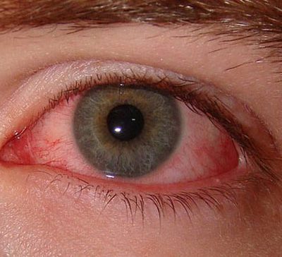 تأثیر آلودگی هوا بر چشم