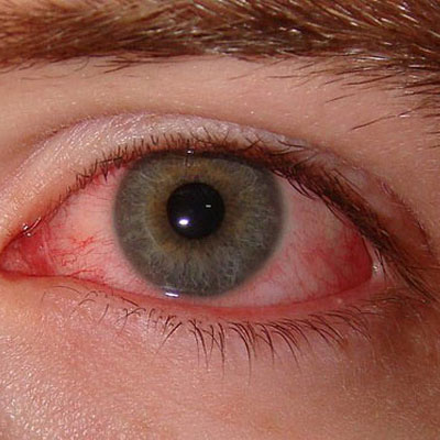 تأثیر آلودگی هوا بر چشم